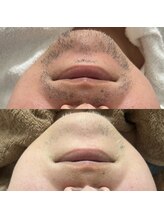 ランプ(LAMP)/～ハイブリッドヒゲ脱毛～