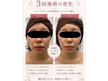ステラ(Stella)の写真/   歯の食いしばり 顔まわりのもたつきに◎すっきり美フェイスへ