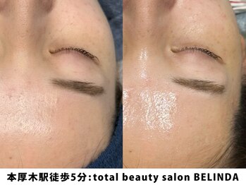 ベリンダ(BELINDA)/セルマンピーリング