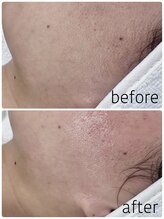 グレイス アンド ミューズ(grace&muse)/産毛waxうるすべ肌実感コース