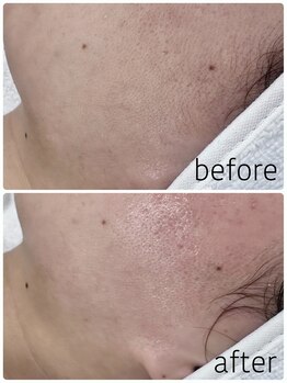 グレイス アンド ミューズ(grace&muse)/産毛waxうるすべ肌実感コース