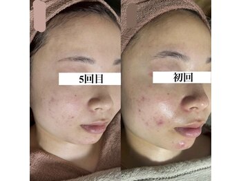 アルムダアクア 天王寺店(Aleumda AQUA)/ハーブピーリング/大阪/天王寺