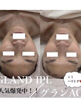 コアラッシュ(COA LASH)/最新光フェイシャル【KIWAMI】