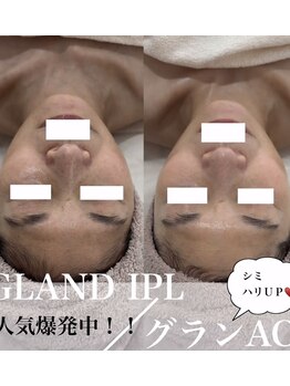 コアラッシュ(COA LASH)/最新光フェイシャル【KIWAMI】