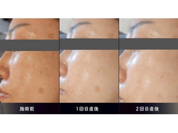 ミュウ 心斎橋店(MYU)/[ダクトピール]ビフォーアフター