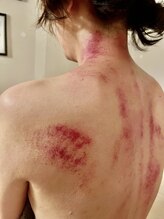 船橋ウィメンズ鍼灸院/カッサの痕