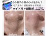 ★毛穴/黒ずみ/艶肌ハイドラ+顔脱毛 －20℃ヒト臍帯血幹細胞上清 導入 80分