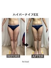 リヘッド(Re.head)/ハイパーナイフEX 全身痩身