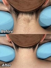 レイビス 札幌店(RAYVIS)/意外と見られてる！？うなじ脱毛