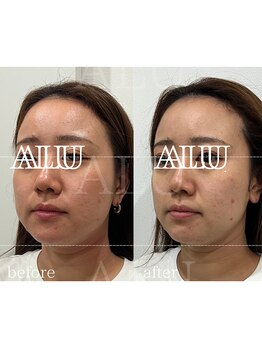 アルフォービューティー 難波店(ALU for beauty)/オンダリフト症例