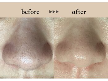 ソーヴ(SOLVE)/松ヤニWax脱毛1回 Before→after