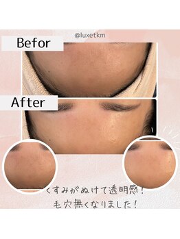 リュクス(Luxe+TKM HANATEN)/毛穴も変わる ララピーリング