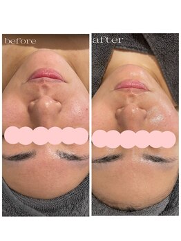 サロンドエテ(salon de ete)/肌ざらつきくすみ改善ツヤ肌爆誕