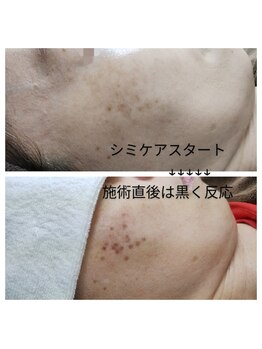 エステの森ジュジュ/シミケア直後