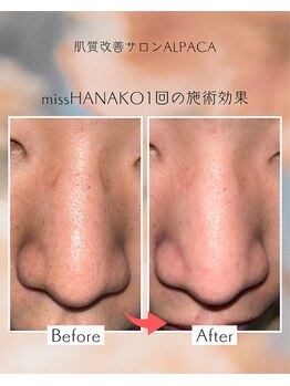 アルパカ(ALPACA)/missHANAKO