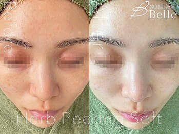 ベル 札幌(Belle)/ハーブピーリング｜ニキビケア