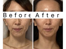 アンシャンテ(Enchant)/お肌の巡りアップで肌荒れ改善