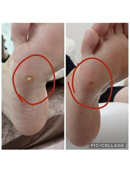 遊歩堂/小指下の魚の目痛みあり