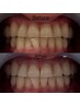【セルフホワイトニング】導入記念|お試し♪1セット2回