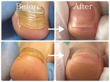 巻き爪補正店 大曽根店/【変形爪/分厚い爪 再生補正】