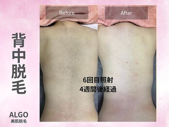 アルゴ 山口宇部店(ALGO)/脱毛初!全身脱毛6回目経過