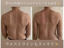 ウララカ(uraraka)/背中が変わればバストも変わる！