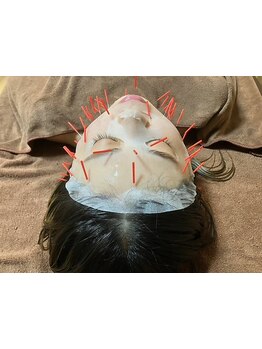 鍼灸施術を受けたい