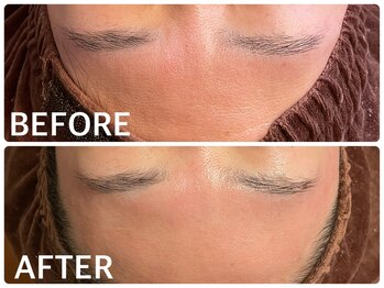 ハーブピーリング 恵比寿/毛穴/透明感