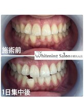 ホワイトニングサロン 京都烏丸店/4回照射　ホワイトニング施術例