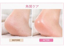 リフト(Re:ft)の雰囲気（角質ケア　痛いタコや魚の目を除去します☆　　　　[フットケア]）