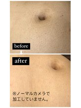 ツリービューティー(Tree Beauty)/before after