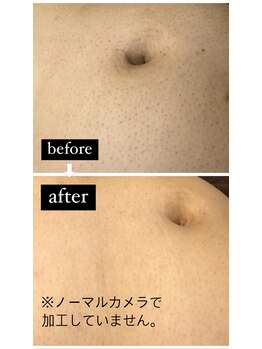 ツリービューティー(Tree Beauty)/before after