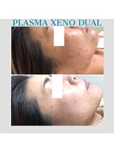 ビーダブリュー(BW...)/肌質改善プラズマゼノデュアル☆