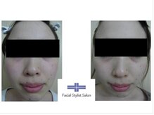 フェイシャルスタイリストサロン 四谷店/ケア例（67）