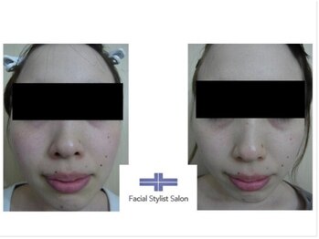 フェイシャルスタイリストサロン 四谷店/ケア例(67)