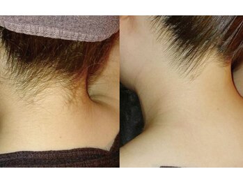 アネル 美里店(anel)/10代～60代まで人気の襟足脱毛♪