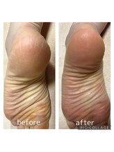 トータルビューティサロン リボーテ(Re:Beaute)/ツルツル かかとケア