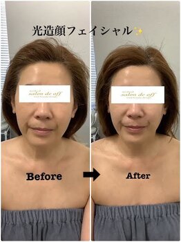 メディカルサロンドオフ 堺東店(medical salon de off)/光造顔フェイシャル★ &nbsp;施術前後
