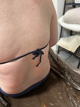 ラペ(la paix)/ボディ症例写真/40代