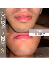 アカラビューティー(Akala Beauty)/ひげ脱毛〈２回終了！〉