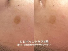 ピブ(pib.)/痛みもあるけど効果もあり！！！