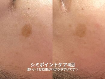 ピブ(pib.)/痛みもあるけど効果もあり！！！