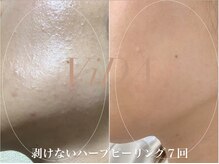 ヴィーダ 渋谷松濤(ViDA)/敏感肌/繰り返す肌荒れ改善