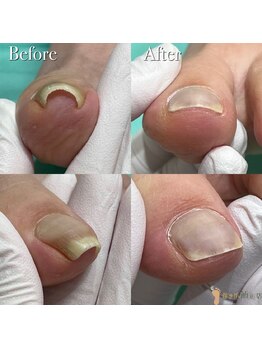 巻き爪補正店 越谷店/巻き爪ケア