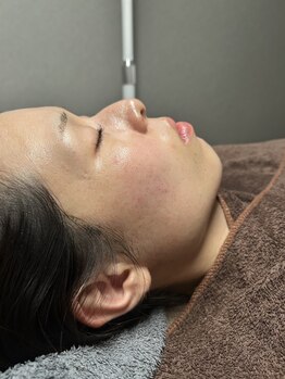 スムー かほく店(Smoo)の写真/肌本来が持っている力を活性化するダウンタイム無ハーブピーリングで、美肌を♪