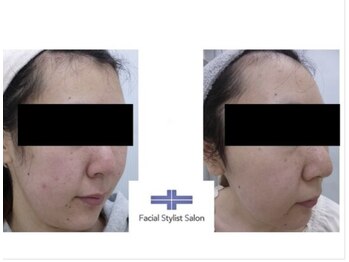 フェイシャルスタイリストサロン 四谷店/ケア例(68)