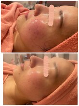 ヒメミ(Himemi)/BBL光エステ６回目お写真