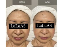 ルルアス(LuLuAS)の雰囲気（エイジング特化プラズマフェイシャル一回の効果）