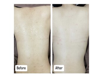 エミルカ 新宿(EMILUCA)/長年のシミもお任せください