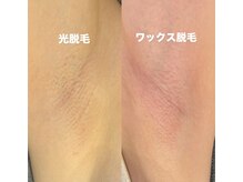 ルーム303(Room303)/春の前に部分脱毛でキレイを！